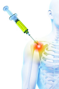 Subacromial corticosteroid injection
