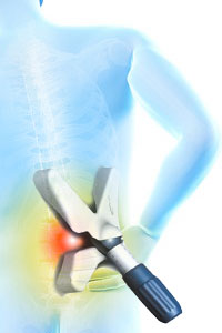 Low Back Pain Surgery NYC